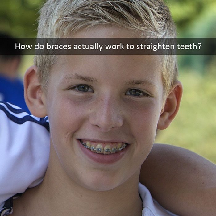 how-braces-work-2022_700.jpg
